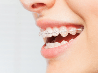 Close-up profile of ceramic braces | Nudera Orthodontics