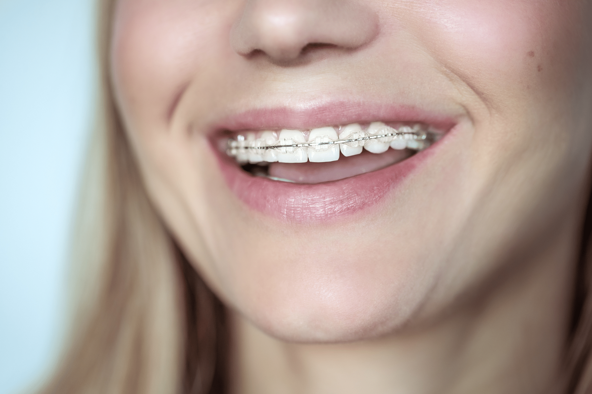 Close-up of smile with metal braces | Nudera Orthodontics