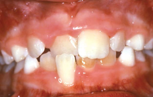 Close-up of misaligned child's teeth | Nudera Orthodontics