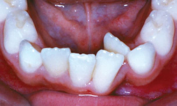 Close-up of crooked bottom teeth | Nudera Orthodontics