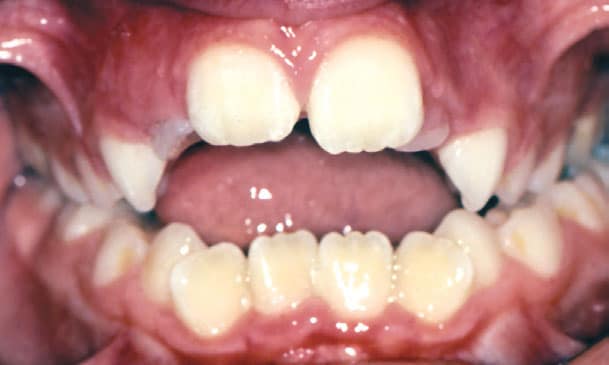View of an overbite before treatment | Nudera Orthodontics
