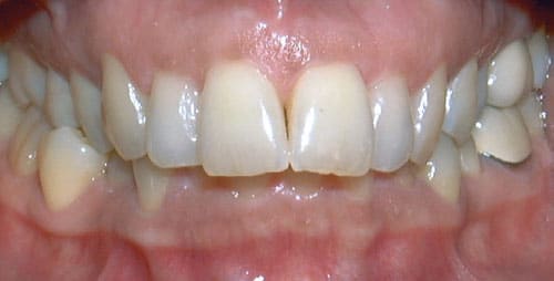 Close-up of straight upper teeth | Nudera Orthodontics