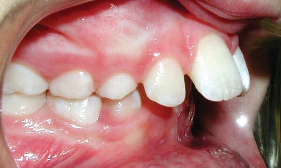 Intraoral view of teeth misalignment | Nudera Orthodontics
