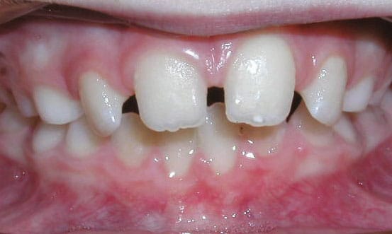 Close-up of gap between front teeth | Nudera Orthodontics
