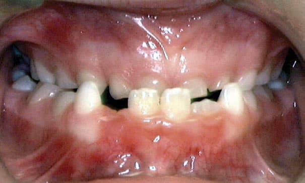 Intraoral view of crowded lower teeth | Nudera Orthodontics